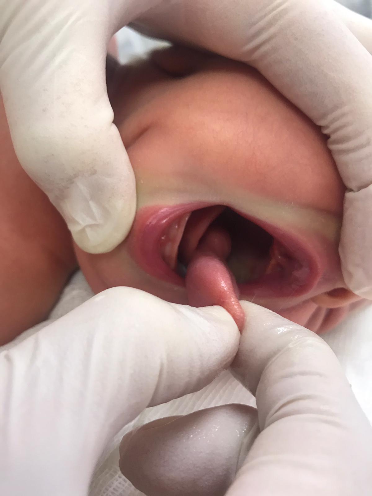 Çift dilli doğan Zeynep bebeğin ikinci dili ameliyatla alındı