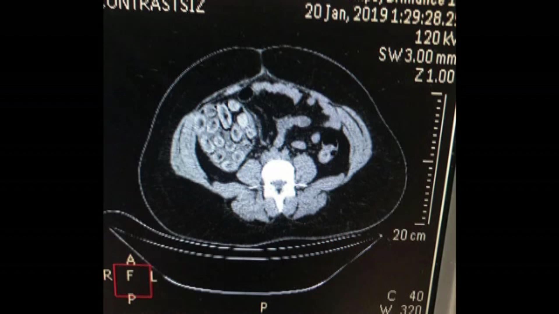 Brezilyalı kadının midesinde kokain dolu 115 prezervatif çıktı