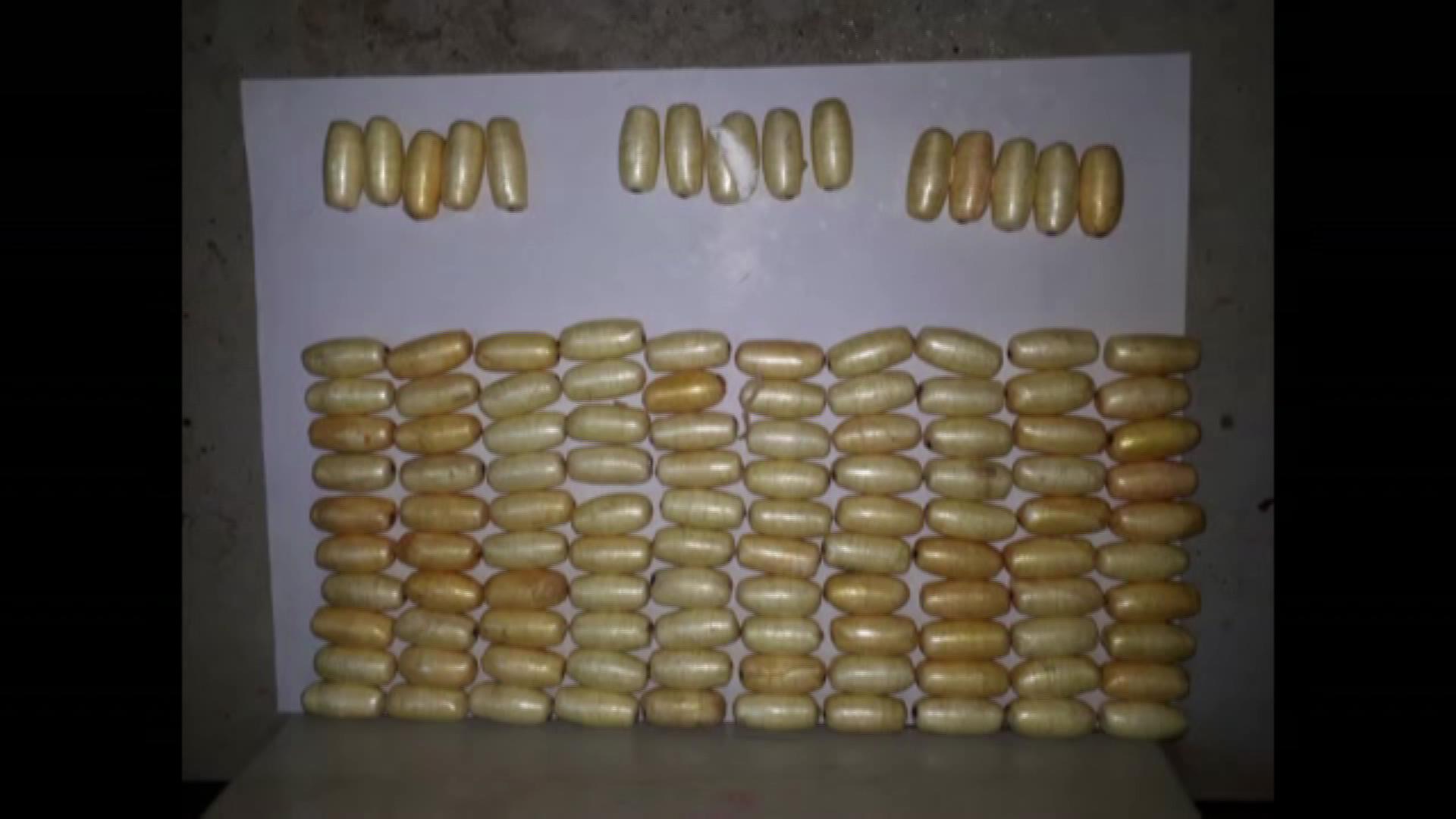 Brezilyalı kadının midesinde kokain dolu 115 prezervatif çıktı