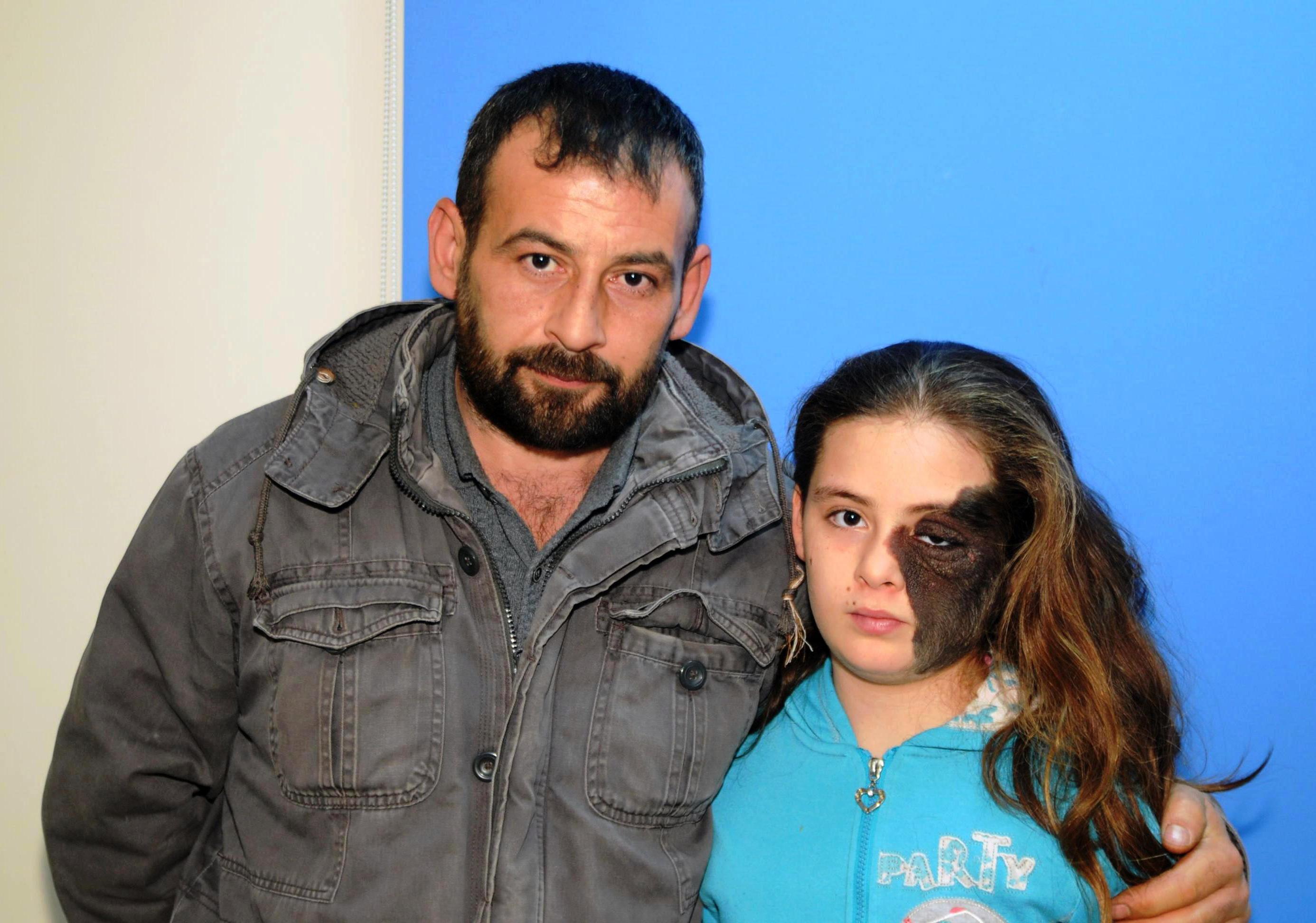 Yüzünde dev ben olan Nazlı, AÜ Hastanesinde tedavi olacak