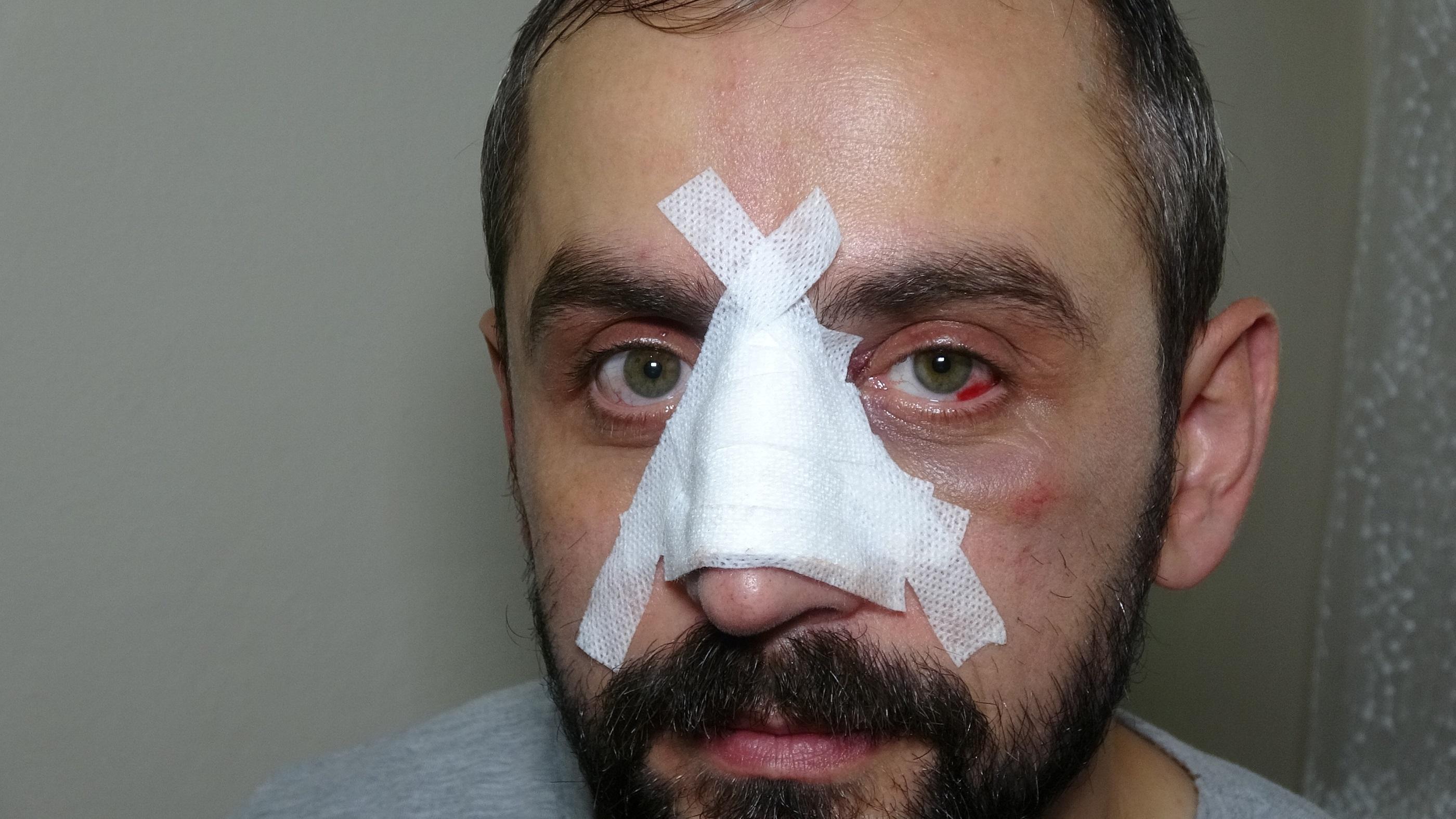 DHA muhabirine çirkin saldırı: Kısıtlamayı ihlal eden boksör, gazetecinin burnunu kırdı