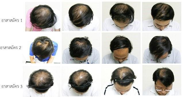 Taylandlı bilim insanları kelliğe çare olabilecek bir öz keşfetti