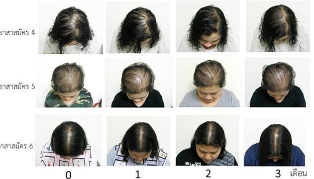 Taylandlı bilim insanları kelliğe çare olabilecek bir öz keşfetti