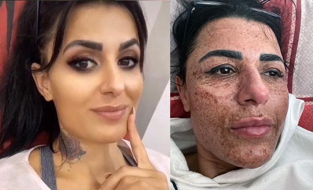 Gittiği güzellik merkezleri yüzünü yaktı, harcadığı parayı isteyince tehdit edildi