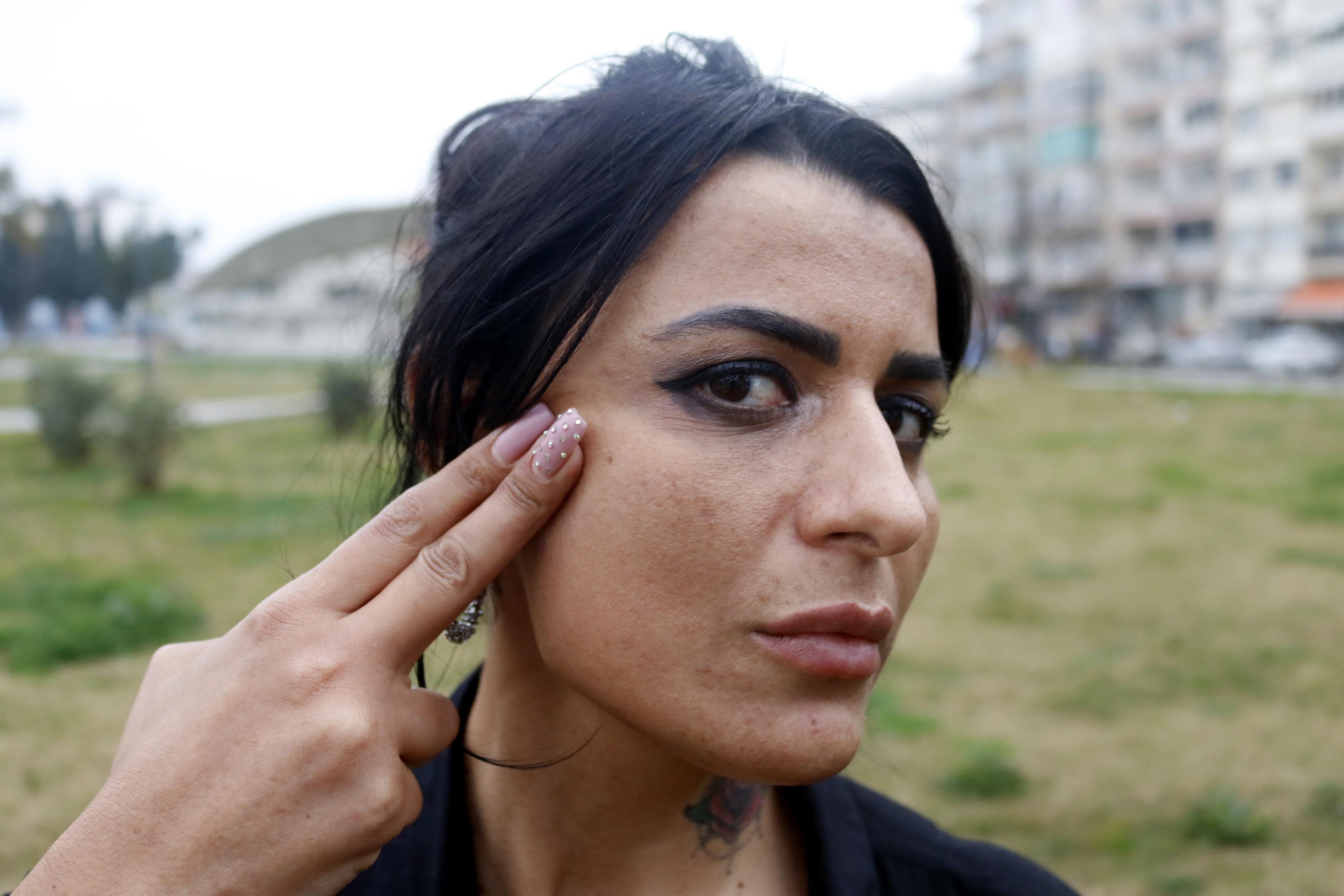 Güzellik merkezinde yüzü yanan Aslı: Sosyal medyadaki reklamlarına kandım