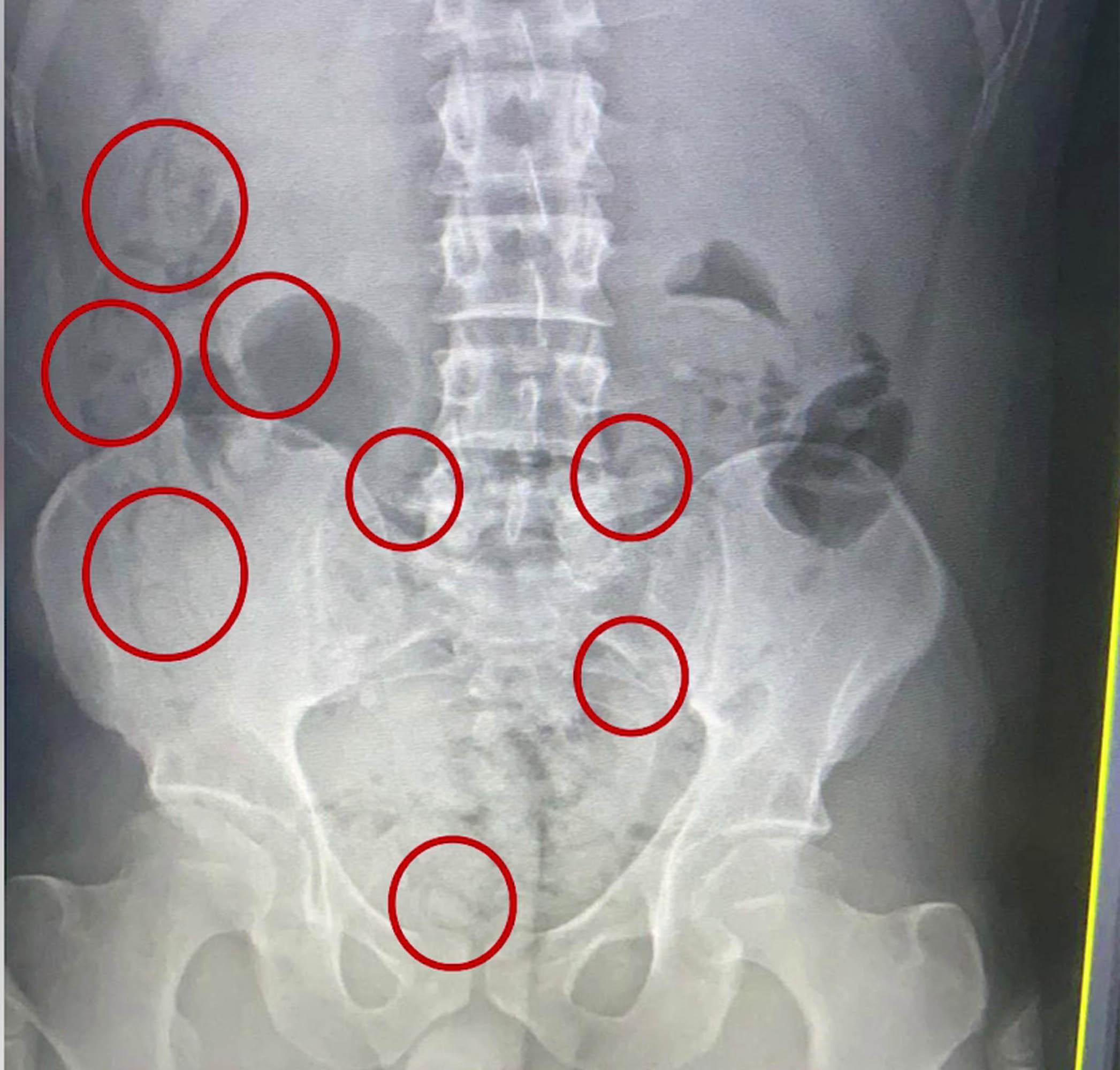 İranlının mide ve bağırsağındaki uyuşturucu röntgende ortaya çıktı