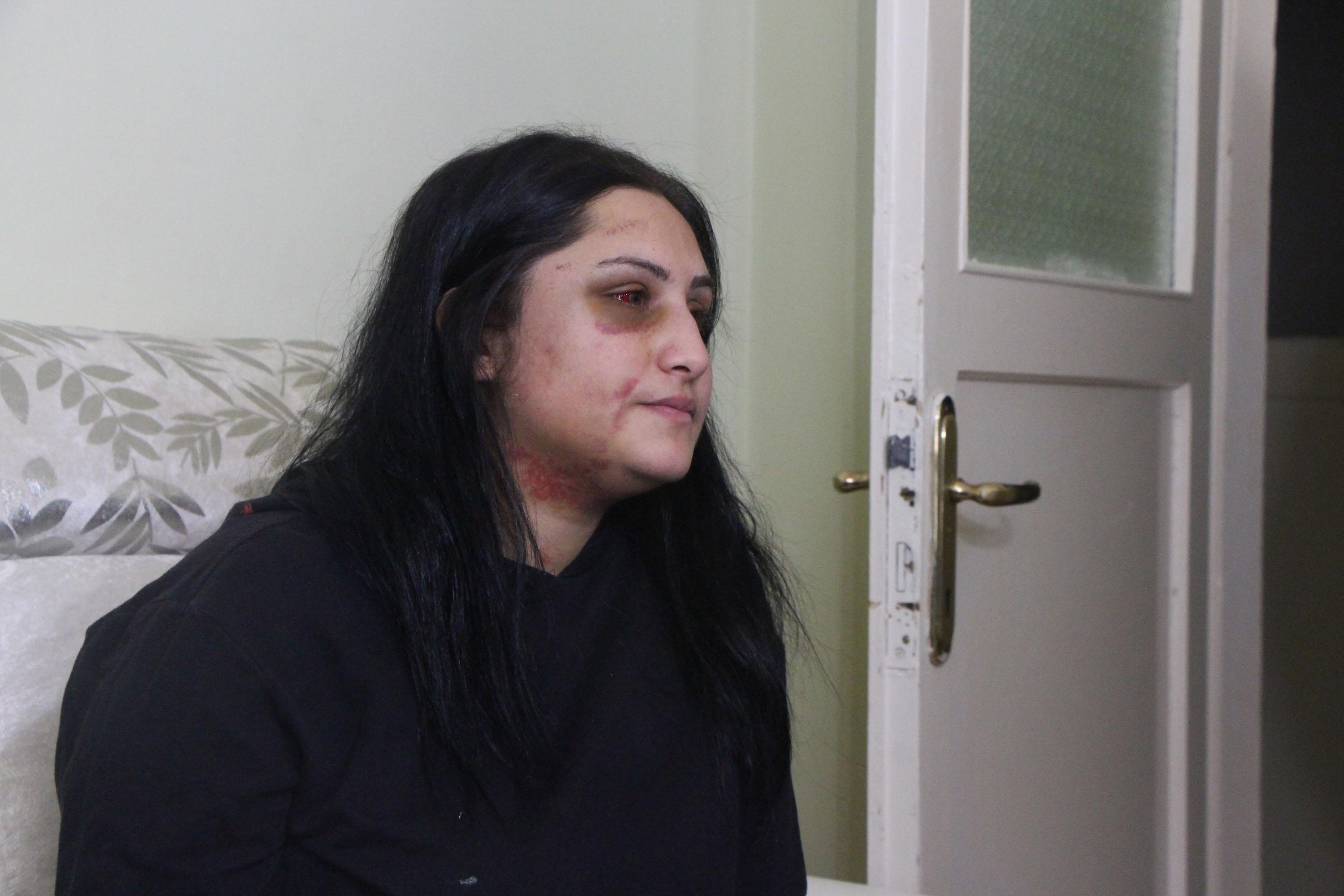 Samsunda eski eşinin dövdüğü kadın: Şiddet sessiz kalındıkça çoğalıyor