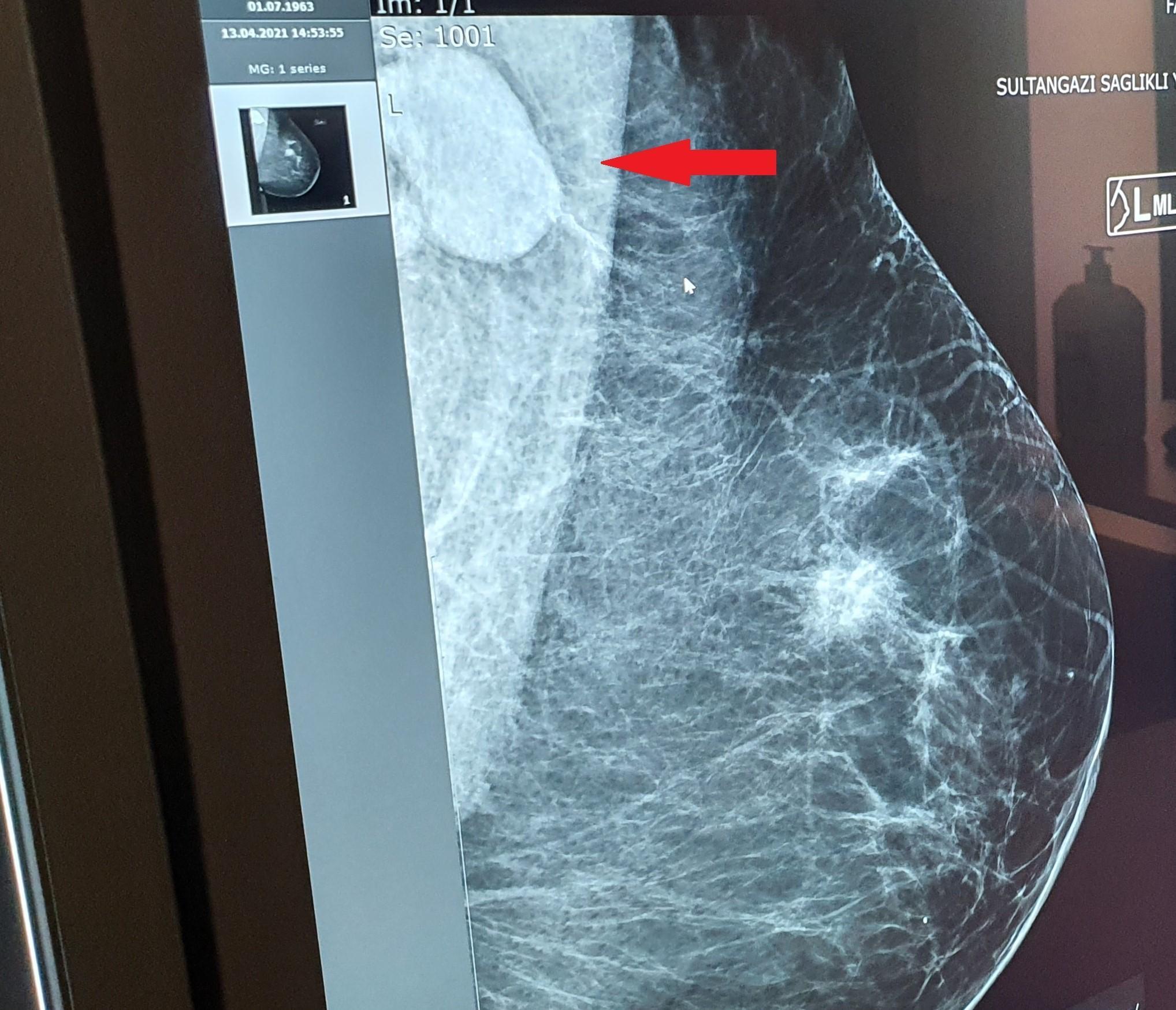 Radyoloji Uzmanı Yrd. Doç. Dr. İkizceli: Aşılamaya bağlı tek taraflı lenf bezi tutulumu, meme kanseriyle karışabilir