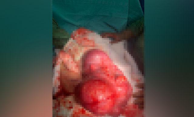 Anne karnında savaştı; doktorların mucize bebeği...