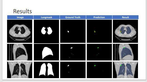 Yapay zeka ile yüzde yüze yakın doğrulukla birkaç saniyede kovid teşhisi