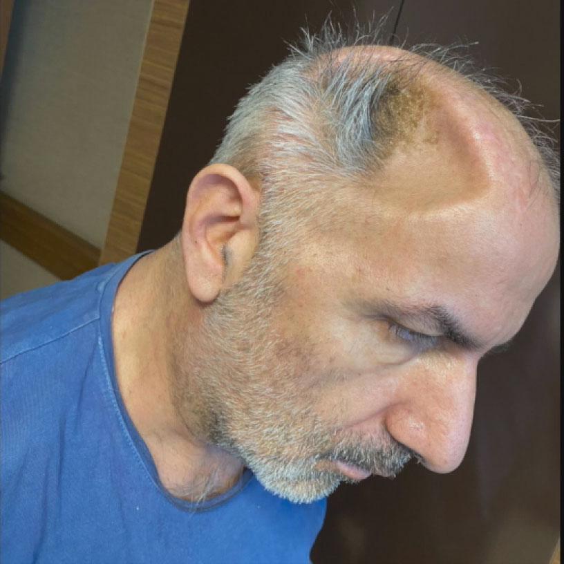 5 ay karnında taşıdığı kafatası kemikleri onu ikinci kez hayata bağladı