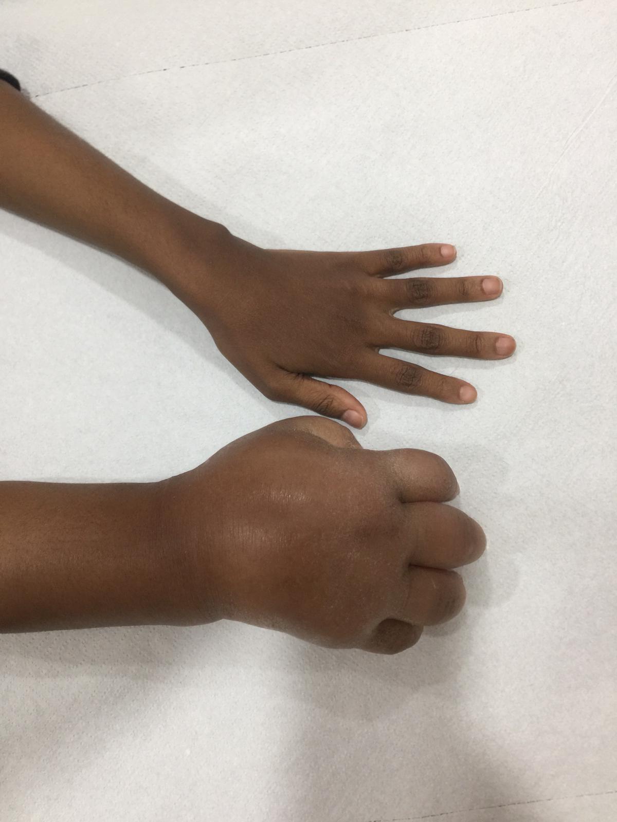 Fil hastalığına yakalanan Nijeryalı kadın Türkiye’de sağlığına kavuştu