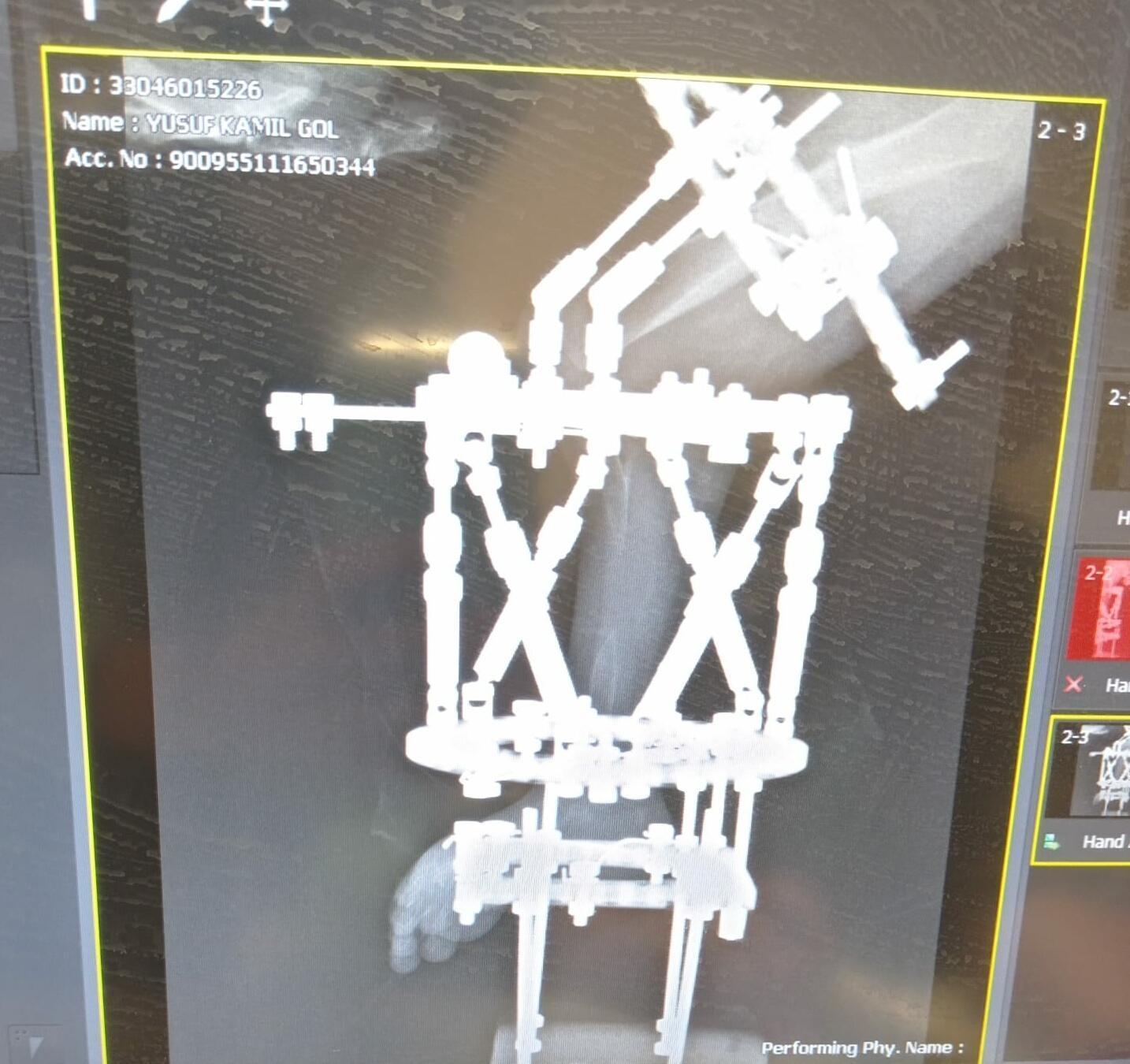 6 ameliyat geçiren Yusuf Kamil artık yürüyebiliyor