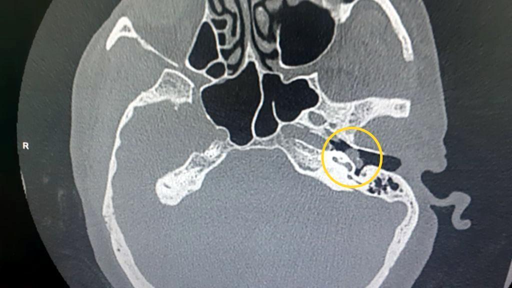 İşitme kaybı yaşayan hemşirenin kulağındaki tümör ameliyatla alındı