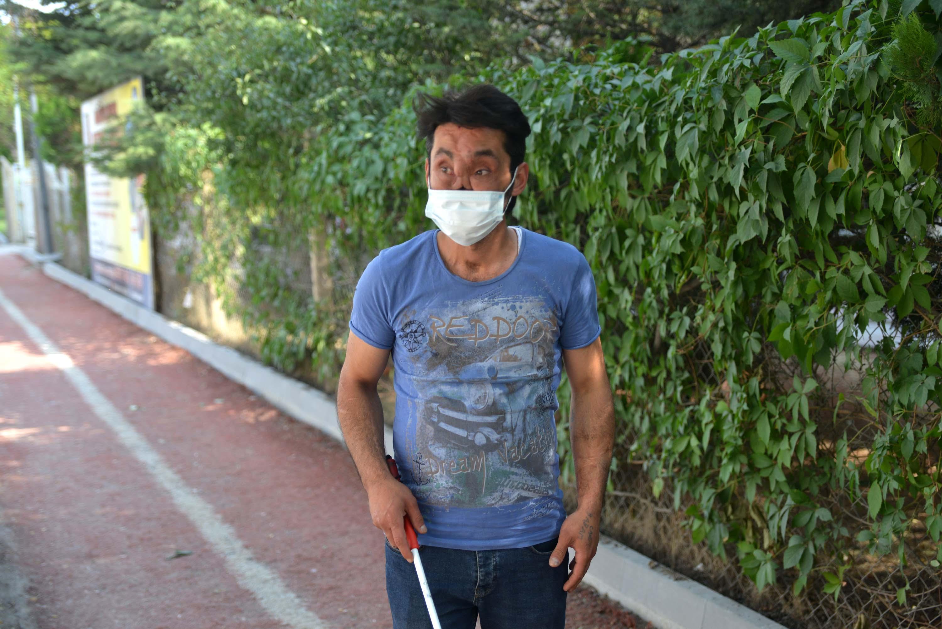 Yüzünün yarısını kaybeden Ahmetin tek hayali normal insanlar gibi yaşamak