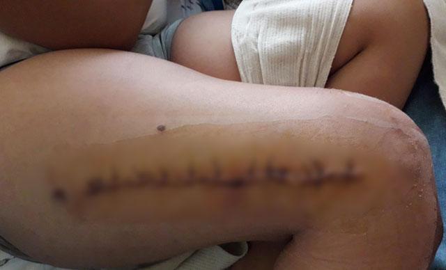 Fizik tedavide bacağı kırılan çocuğun annesine hapis cezası