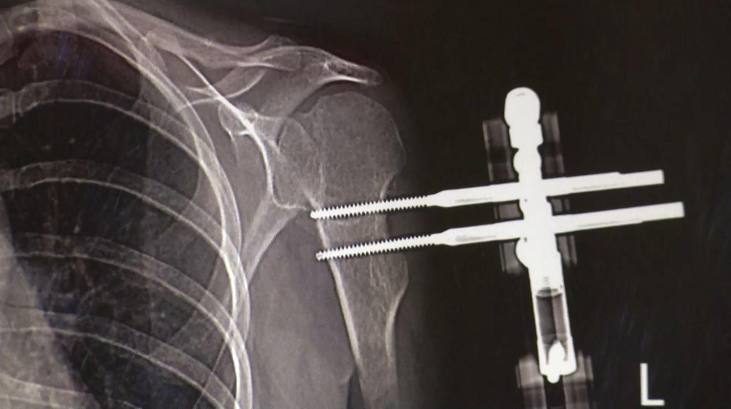 Op. Dr. Halil Buldu: Boyu kısa olanlar tek ameliyatla 13 santimetreye kadar uzayabiliyor