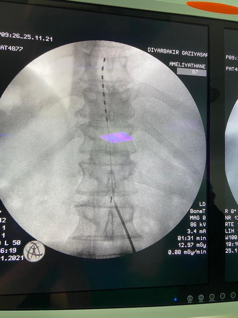 Terör mağduruna, 27 yıldır dinmeyen ağrıları nedeniyle ağrı pili takıldı