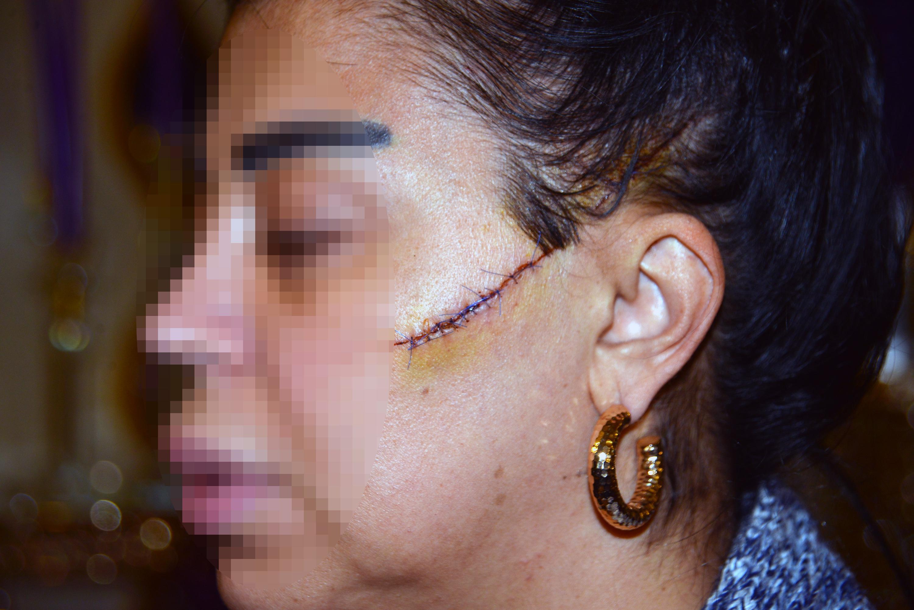 Eski sevgilisinin yüzünü ustura ile kesen şüpheli, tutuklandı