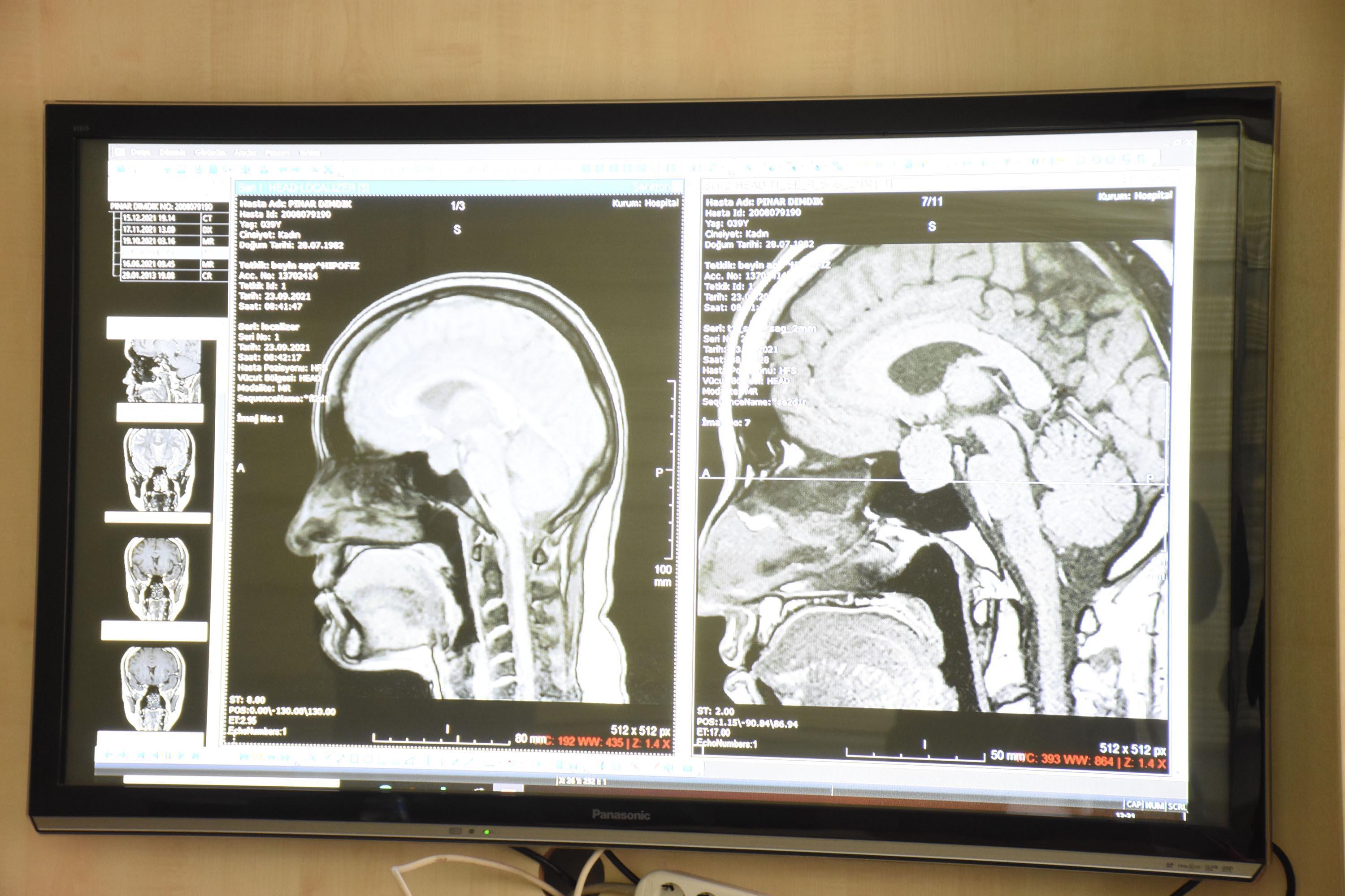 Beyin tümörü bulunan hastaya burundan girilerek interaktif ameliyat