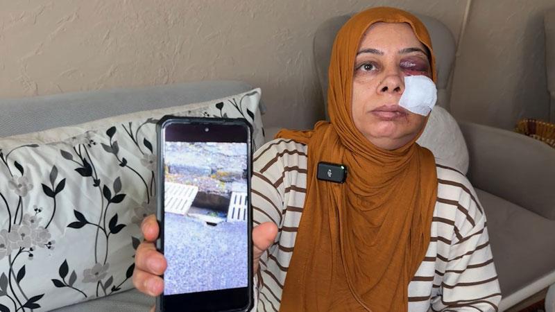 Elektrikli bisikleti ile kapağı kırık rögara düştü; yüzüne 14 dikiş atıldı Elektrikli bisikleti ile kapağı kırık rögara düştü; yüzüne 14 dikiş atıldı