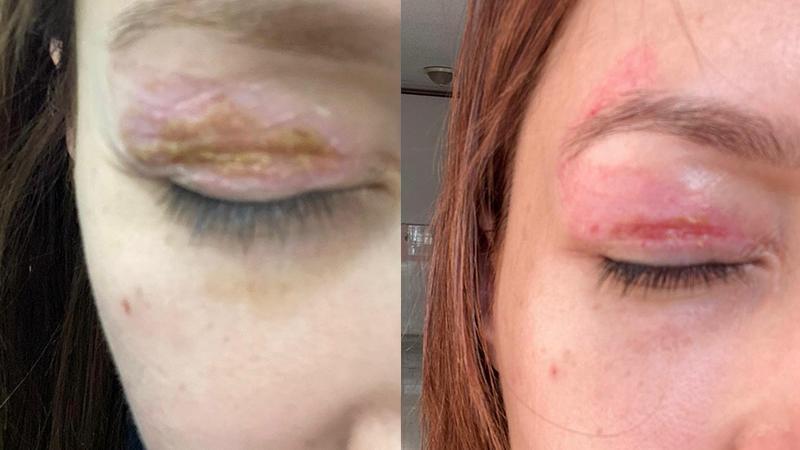 Güzellik salonundaki işlem sonrası gözünde hasar iddiasıyla yaptığı şikayet reddedildi; ‘Uzmanına gidin’ uyarısı yaptı