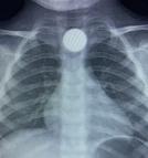 3 yaşındaki Bilal'in, yuttuğu 50 kuruş yemek borusunda takıldı