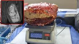 Diyarbakır’da, hastanın bacağından 5 kilo 668 gramlık kitle çıkarıldı