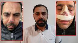 Ameliyat sonrası burnunda iz oluştuğunu iddia edip, tedavi masrafı için hastaneye dava açtı