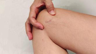 ‘Lipödem, selülit gibi yüzeysel bir kozmetik sorun değil’