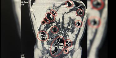 Yabancı uyruklu 2 kişinin mide ve bağırsaklarından uyuşturucu çıktı