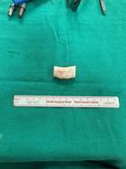 Silopi Devlet Hastanesi’nde kaburga kıkırdağıyla ilk burun rekonstrüksiyonu