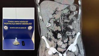 Fas’tan Beşiktaş'a midesinde uyuşturucu getirdi; ameliyatla çıkarıldı