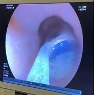 Midesindeki 9 pil, endoskopik yöntemle çıkarıldı