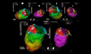 Mersin Şehir Hastanesi’nde kalp ritim bozukluklarına ileri teknolojiyle müdahale