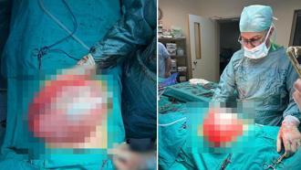 Kilolarından kurtulmak için doktora giden liseli kızın karnından 3,5 kilo ağırlığında kist çıktı