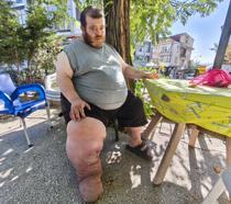 Fil hastası Kazım'ın tedavi olabilmesi için 82 kilo vermesi gerekiyor
