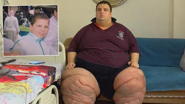270 kilo Mehmet: 15 aydır evden çıkamıyorum, yardım edin