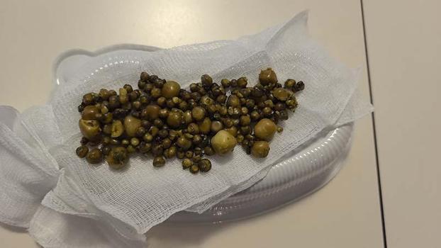 Bursa'da 77 yaşındaki kadının safra kesesinden 213 tane taş çıkarıldı