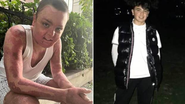 Kağıthane’de kuafördeki yangında tüm vücudu yanan 14 yaşındaki Engin'in tedavisi tamamlandı: Kapı sıkışınca çıkamadım yandım