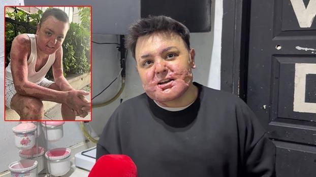 Kağıthane’de kuafördeki yangında vücudu yanan 15 yaşındaki Engin: Mücadeleyi kesinlikle bırakmasınlar ben yılmadım