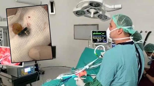 3 mıknatıs yutan 1,5 yaşındaki Faruk, laparoskopi destekli ameliyatla sağlığına kavuştu