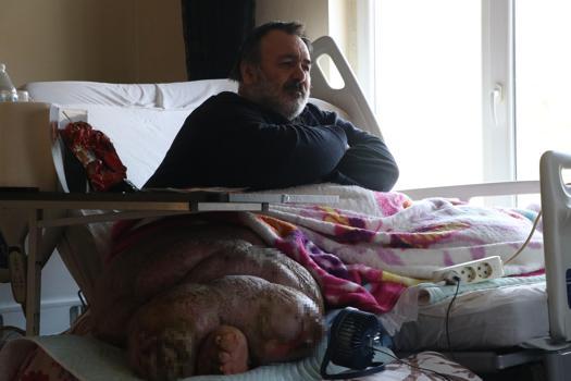 5 yıldır evden çıkamayan 300 kiloya ulaşan fil hastasının hayali; eşiyle kol kola caddede gezmek