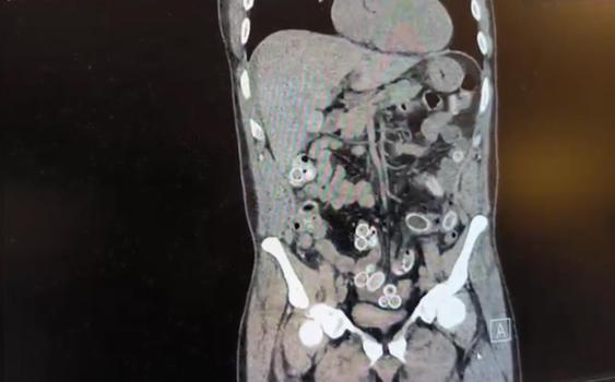 İstanbul - Fas’tan Beşiktaş'a midesinde uyuşturucu getirdi; ameliyatla çıkarıldı