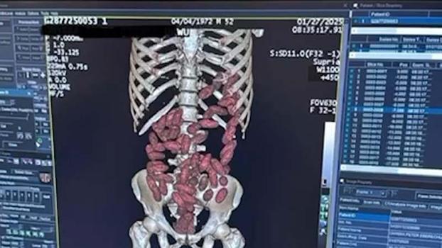 2025’te İstanbul Havalimanı’nda ‘yutucu’ kuryelerden 29,7 kilo uyuşturucu ele geçirildi