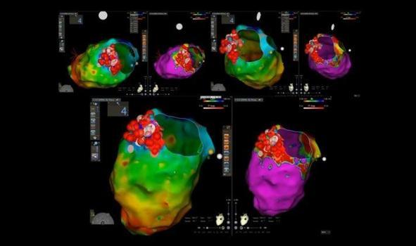 Mersin Şehir Hastanesi’nde kalp ritim bozukluklarına ileri teknolojiyle müdahale