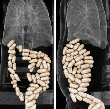2 şüphelinin midesinden 127 kapsül uyuşturucu çıktı