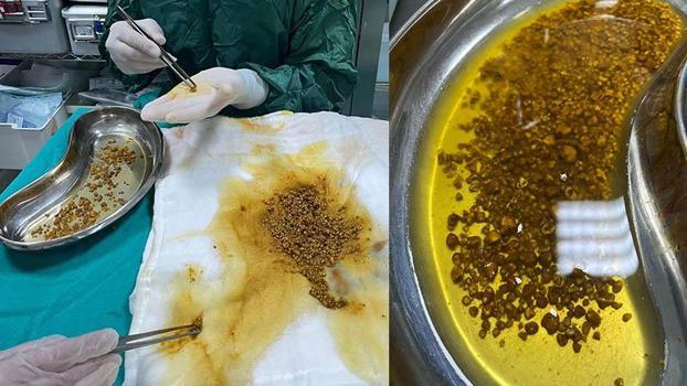 Karın aÄŸrısı ÅŸikayetiyle gittiÄŸi hastanede safra kesesinden 2 bin 67 taÅŸ çıkarıldı