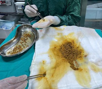 Karın ağrısı şikayetiyle gittiği hastanede safra kesesinden 2 bin 67 taş çıkarıldı