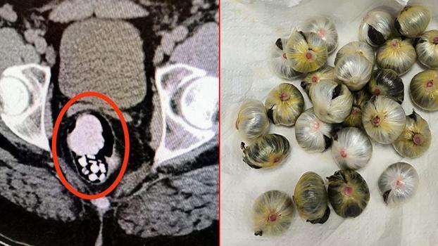 Midesinde uyuşturucu madde bulunan şüpheli, tutuklandı